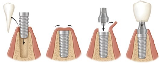 etapele implantarii